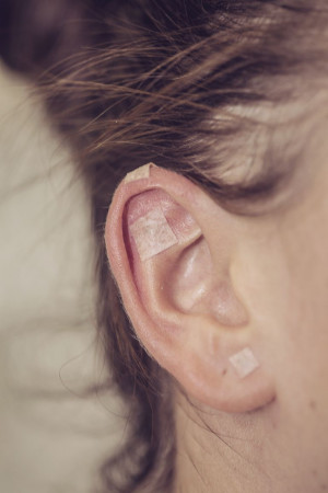 Ohrakupunktur
