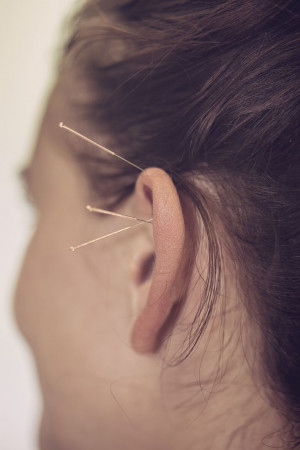 Ohrakupunktur